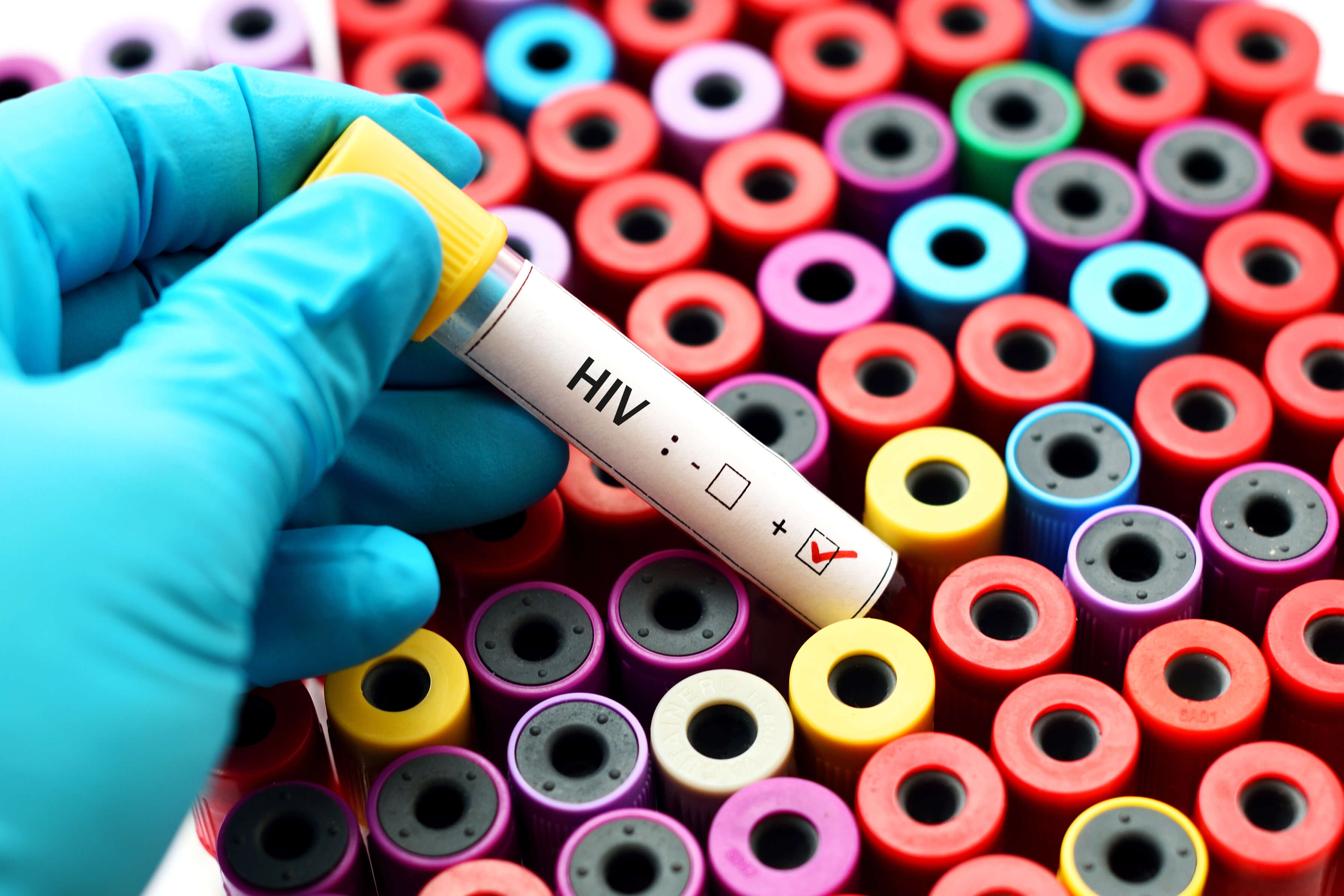 HIV and AIDS