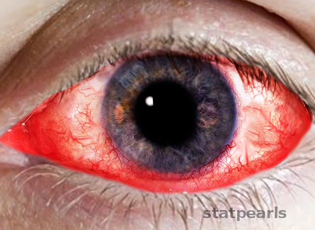 <p>Keratoconjunctivitis
