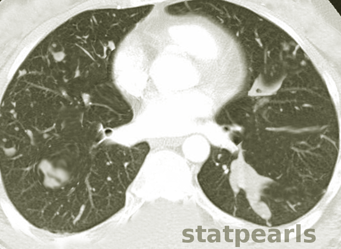 <p>Allergic Bronchopulmonary Aspergillosis</p>