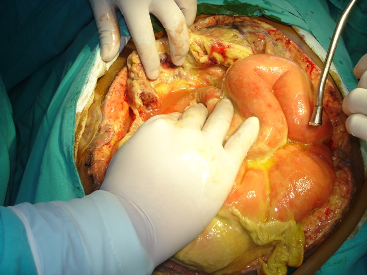 <p>Severe Septic Peritonitis. Image of a patient with severe septic peritonitis requiring abdominal wash out.</p>