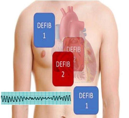 <p>Double Defibrillation Pad Placement. This image shows the correct placement of the pads during double defibrillation.</p>