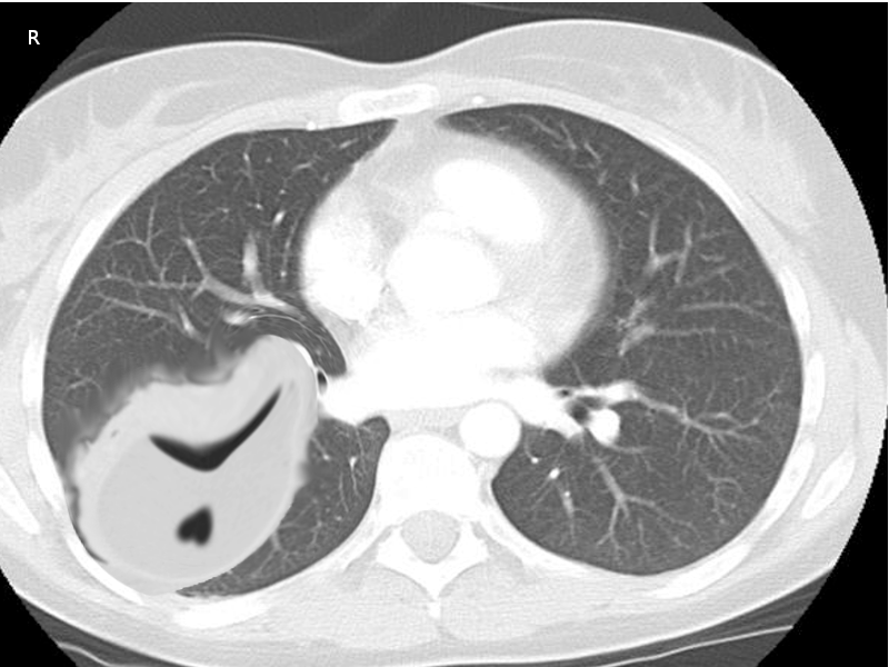 <p>Chronic Empyema, Computed Tomography Scan