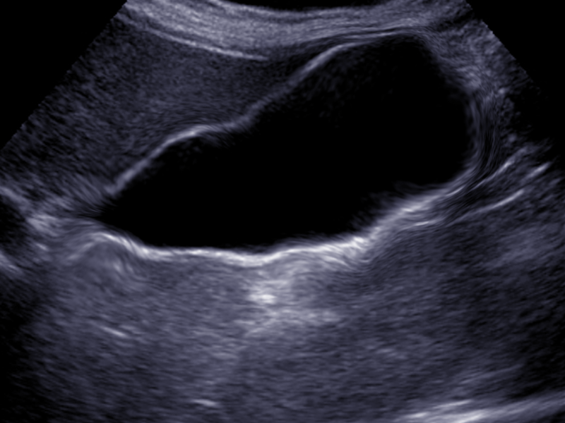 <p>Acalculous Cholecystitis. Ultrasound image in a patient with acalculous cholecystitis.</p>