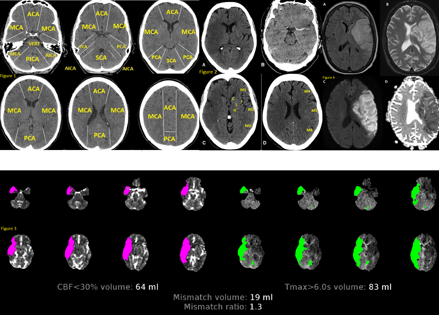 <p>Anatomy of Brain Vascular Territories