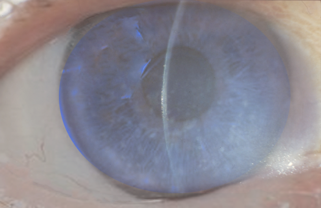 <p>Fuchs Endothelial Dystrophy Findings