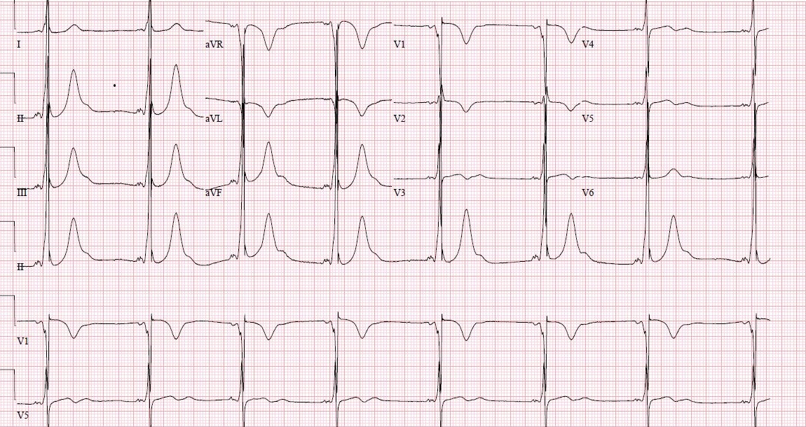 WPW Syndrome Type B