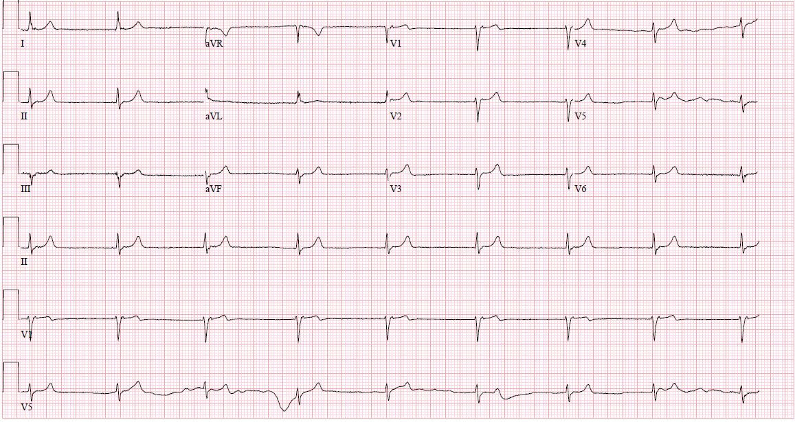 <p>Junctional Rhythm</p>