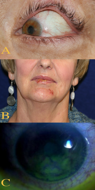 <p>Ocular and&nbsp;Perioral Involvement in Herpes Simplex Virus Infection
