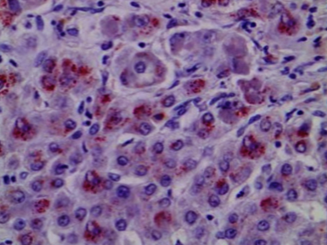 <p>Wilson Disease