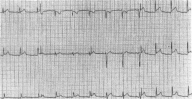 <p>Electrocardiographic Findings in Acute Pericarditis</p>