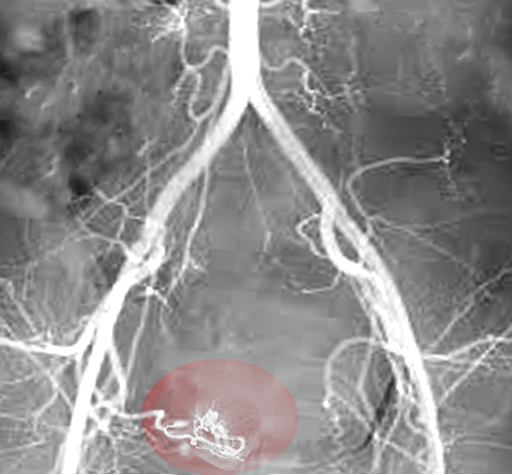 <p>Uterine Artery Embolization. Image of percutaneous transcatheter embolization of the uterine arteries.</p>