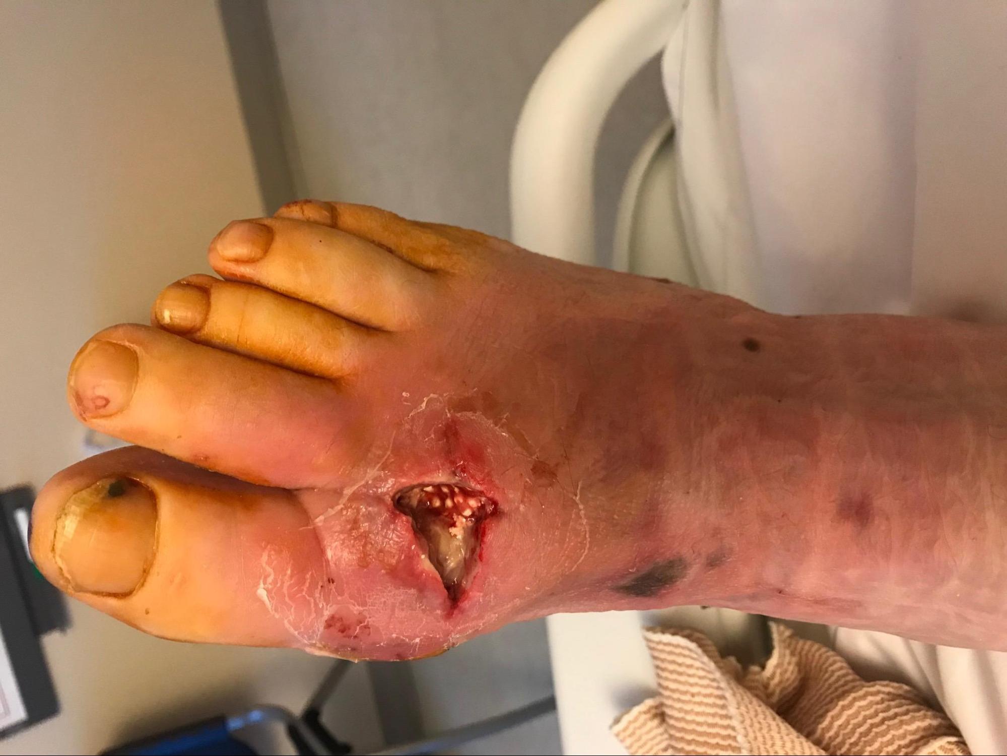 <p>Diabetic Foot Infection Treatment