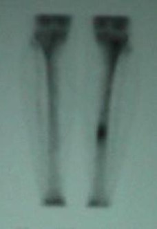 <p>Bone Scan. Image of a 3-phase bone scan showing focal uptake in the tibia&mdash;consistent with stress fracture.</p>