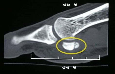 <p>Sesamoid Stress Fracture. CT scan showing a sesamoid stress fracture.</p>