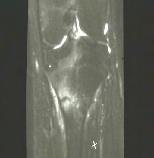 <p>Grade 4 Stress Fracture. MRI image showing a grade 4 stress fracture.</p>