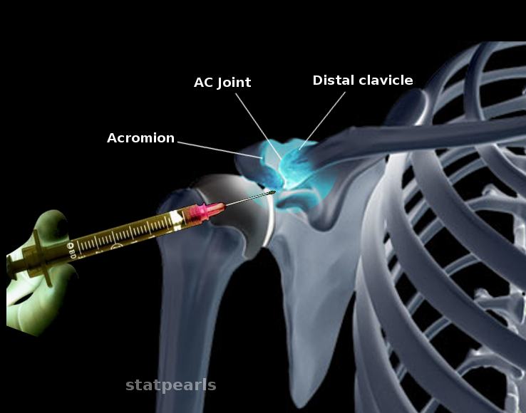 <p>Acromiclavivular Joint Injection
