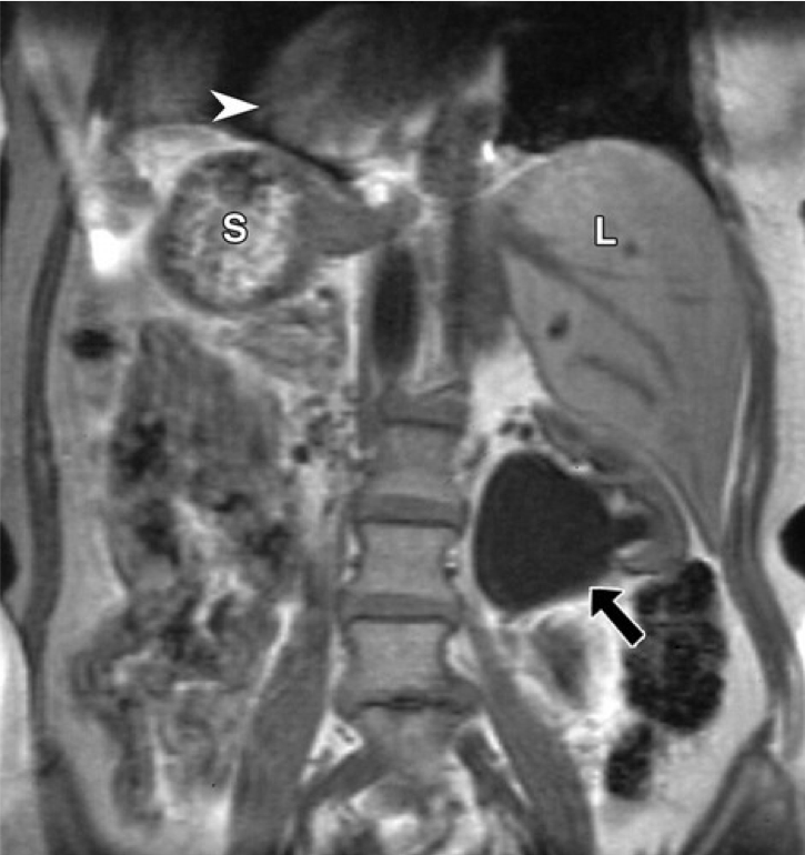 <p>Situs Inversus, Magnetic Resonance Image