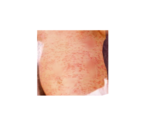 <p>Erythema toxicum