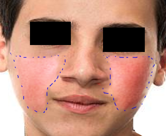 <p>Fifth Disease, Reticular Facial Rash