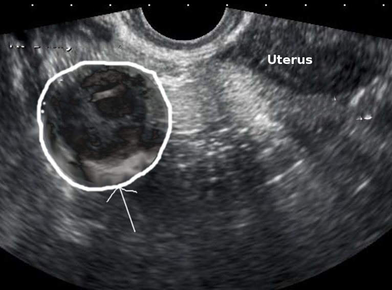 <p>Right Tubo-Ovarian Abscess. Ultrasound image showing a right tubo-ovarian abscess in a patient.</p>