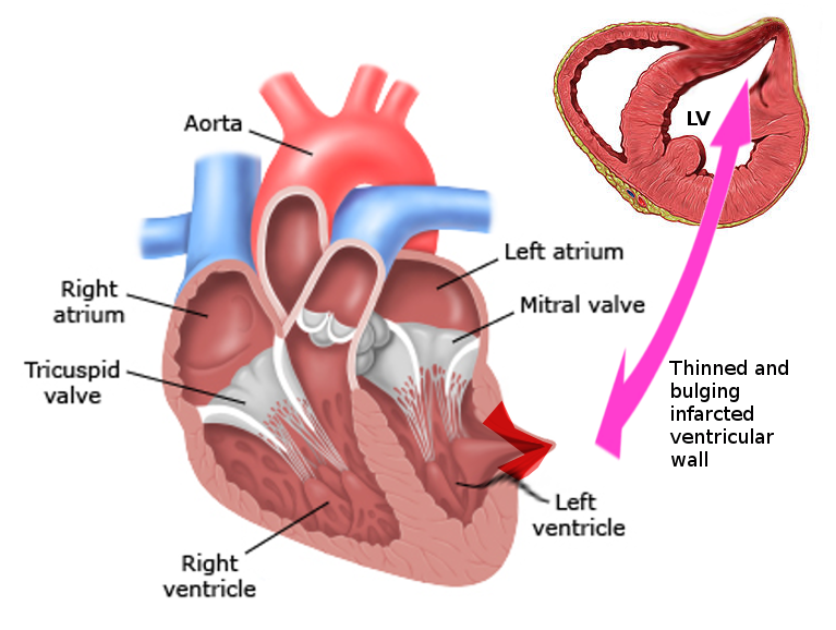 <p>Left Ventricular Pseudoaneurysm. This image shows the anatomy of the heart with a left ventricular pseudoaneurysm.</p>