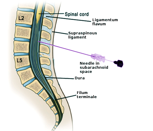 <p>Lumbar Puncture Landmarks