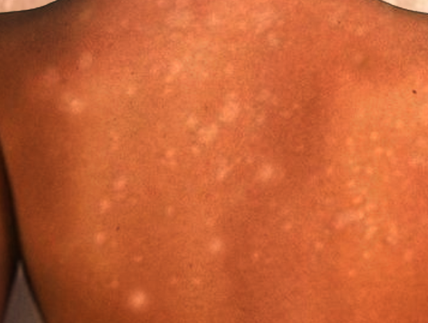 <p>Guttate Hypomelanosis