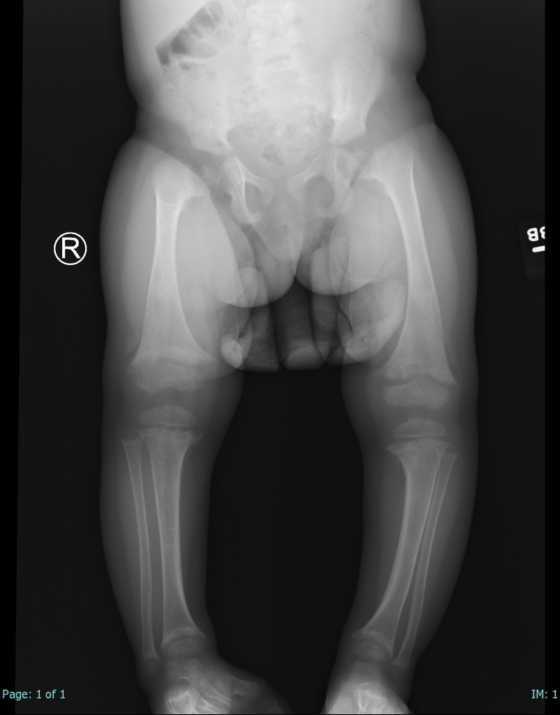 <p>Rickets