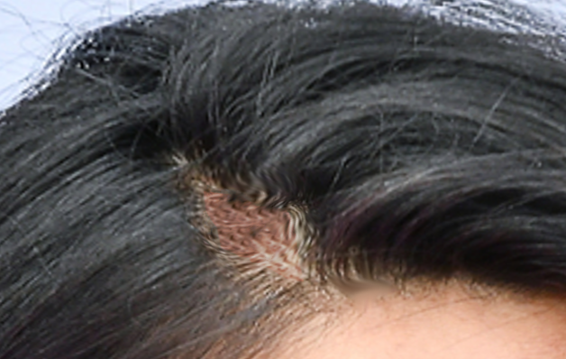 <p>Traction Alopecia, Early Stage