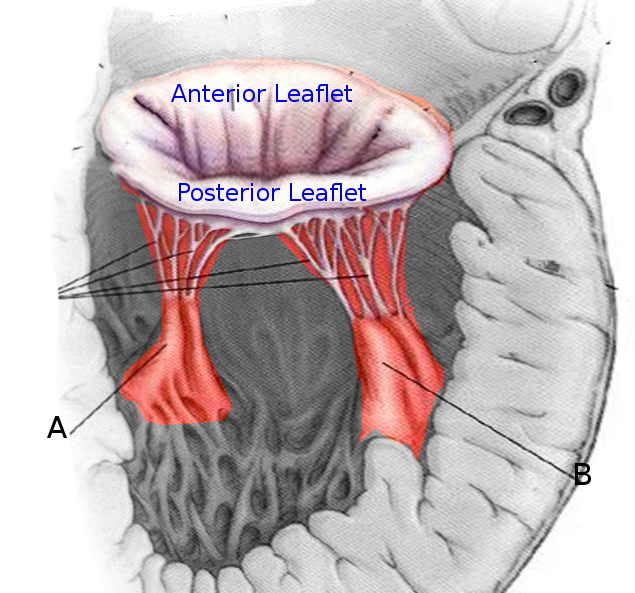 <p>Mitral Valve Leaflets