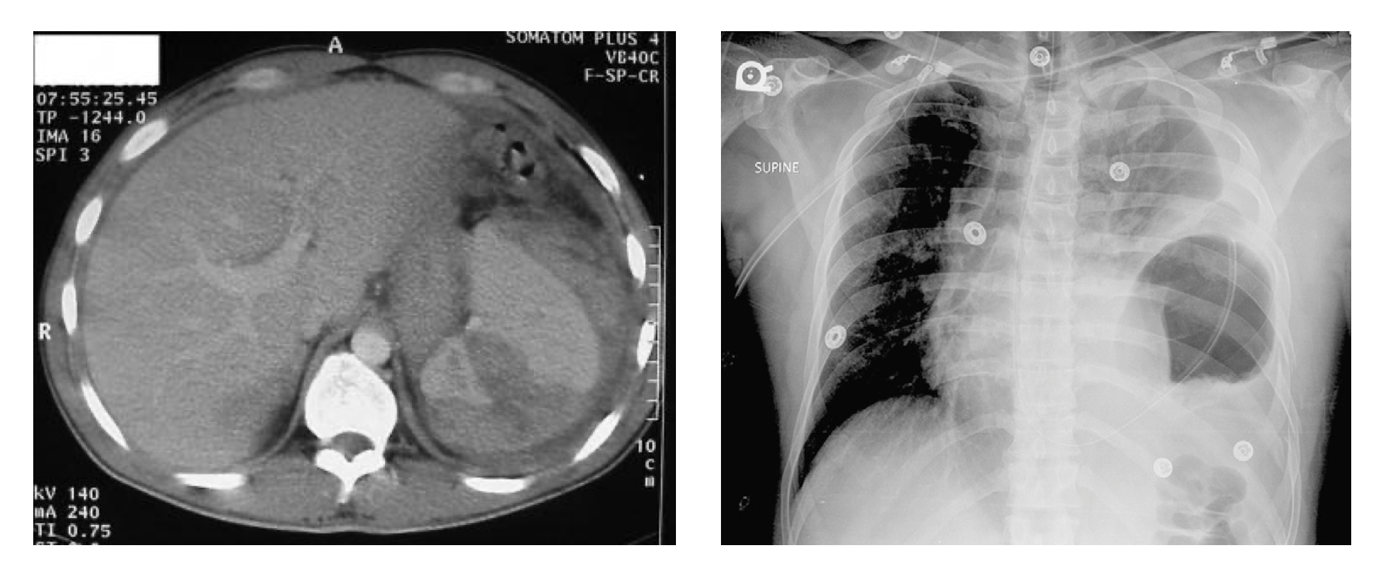 <p>Comparative Analysis of CT and CXR Imaging Findings in Suspected Splenic Injury