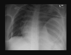 <p>CXR Showing Nasogastric Tube With Left Diaphragmatic Rupture