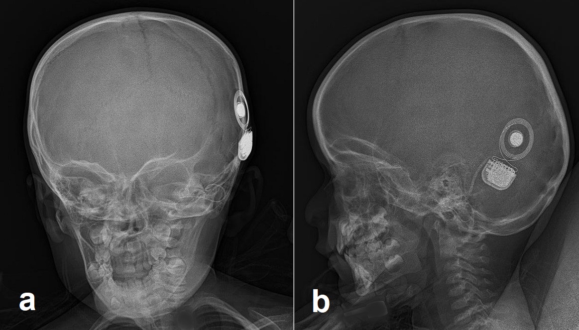 <p>Cochlear Implant Components