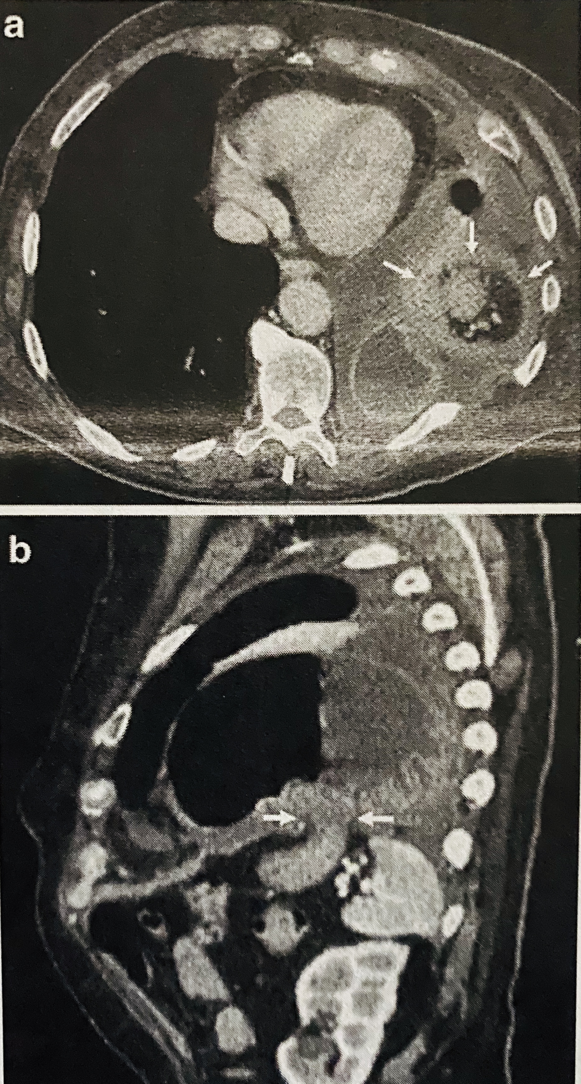 <p>Collar sign showing herniation of the stomach through the left hemidiaphragm with narrowing and thickness at the level of the defect