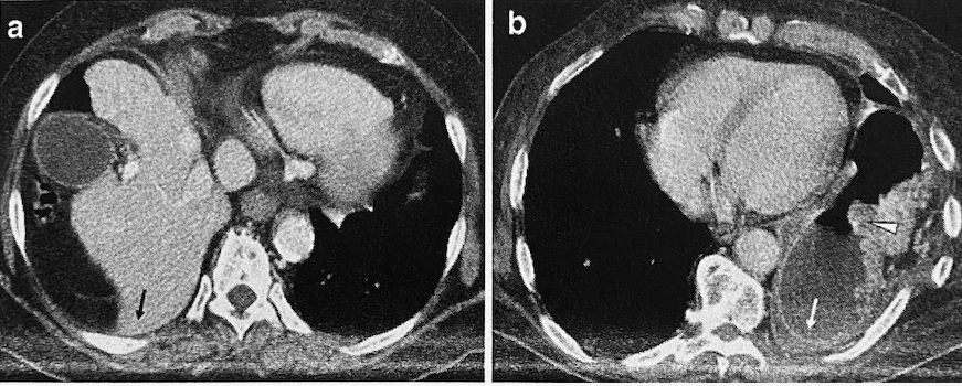 <p>Dependent viscera sign - posterior costophrenic sulcus is obliterated