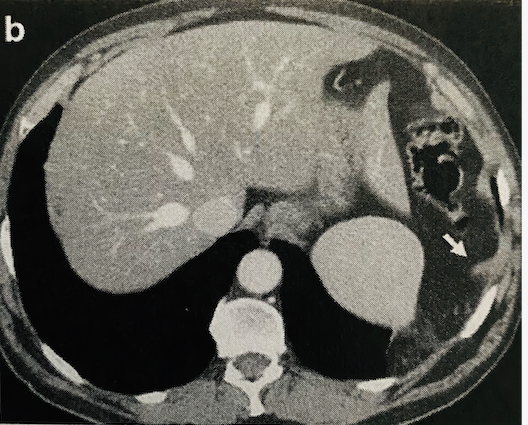 <p>Dangling sign seen on CT scan where the free edge of the torn diaphragm curls inward away from the thoracoabdominal wall