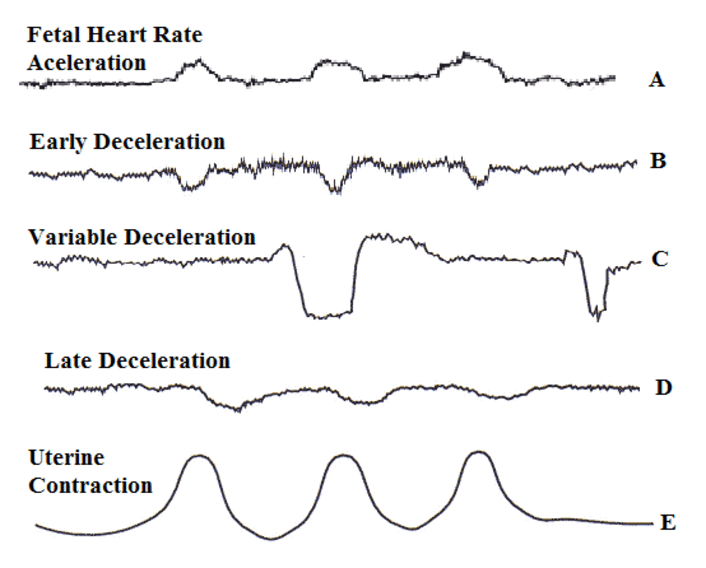 <p>Fetal Heart Rate Changes.</p>