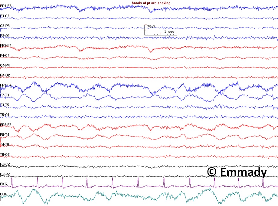 <p>Electroencephalogram Pattern for a Nonepileptic Seizure