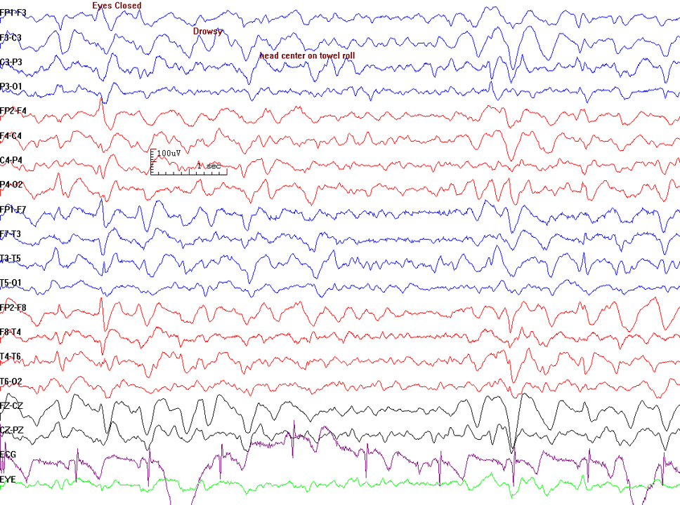 <p>Triphasic Waves