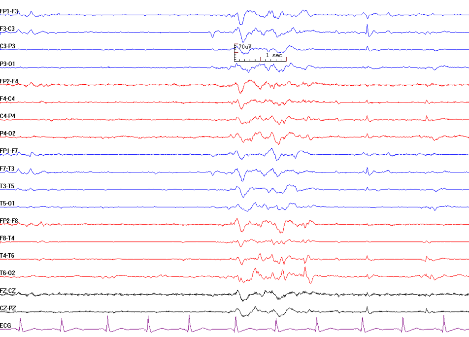 <p>Burst Suppression Pattern