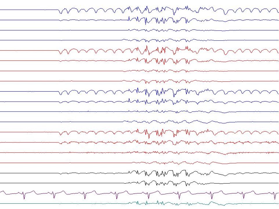 <p>Polyspike-and-Wave