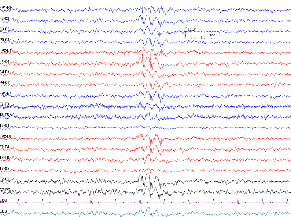 <p>Generalized Spike-and-Wave