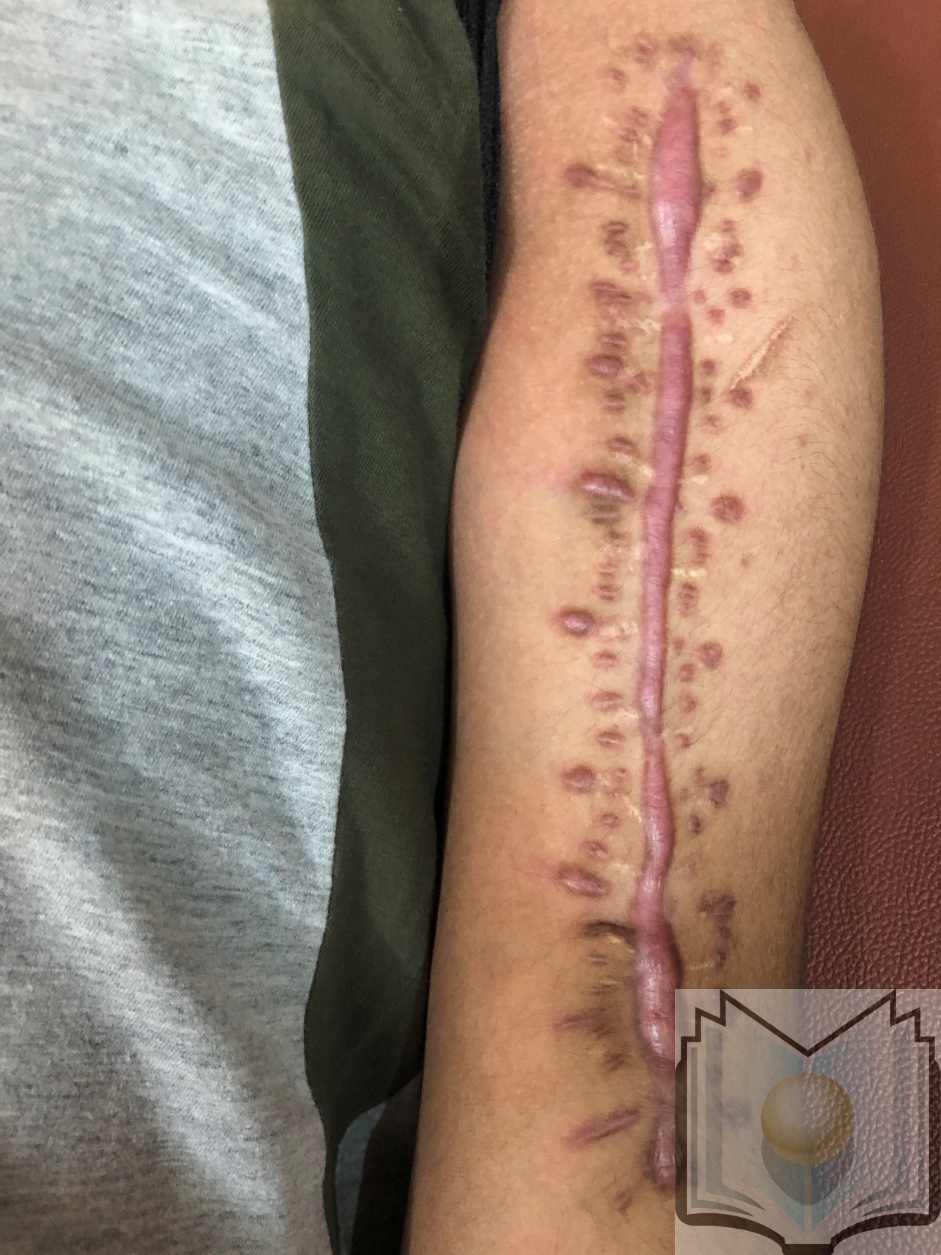 <p>Hypertrophic Scars.</p>