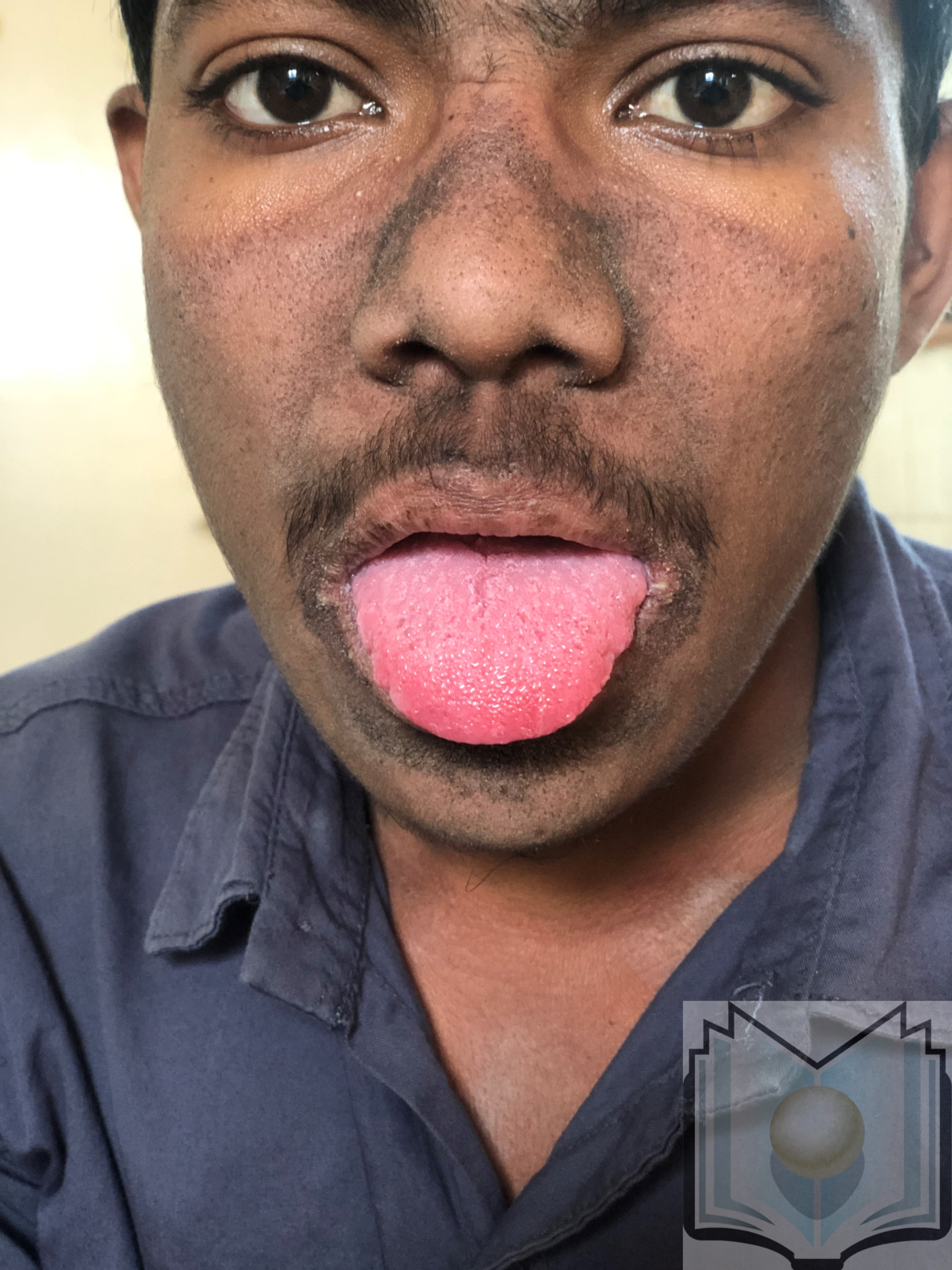 Pellagra Tongue