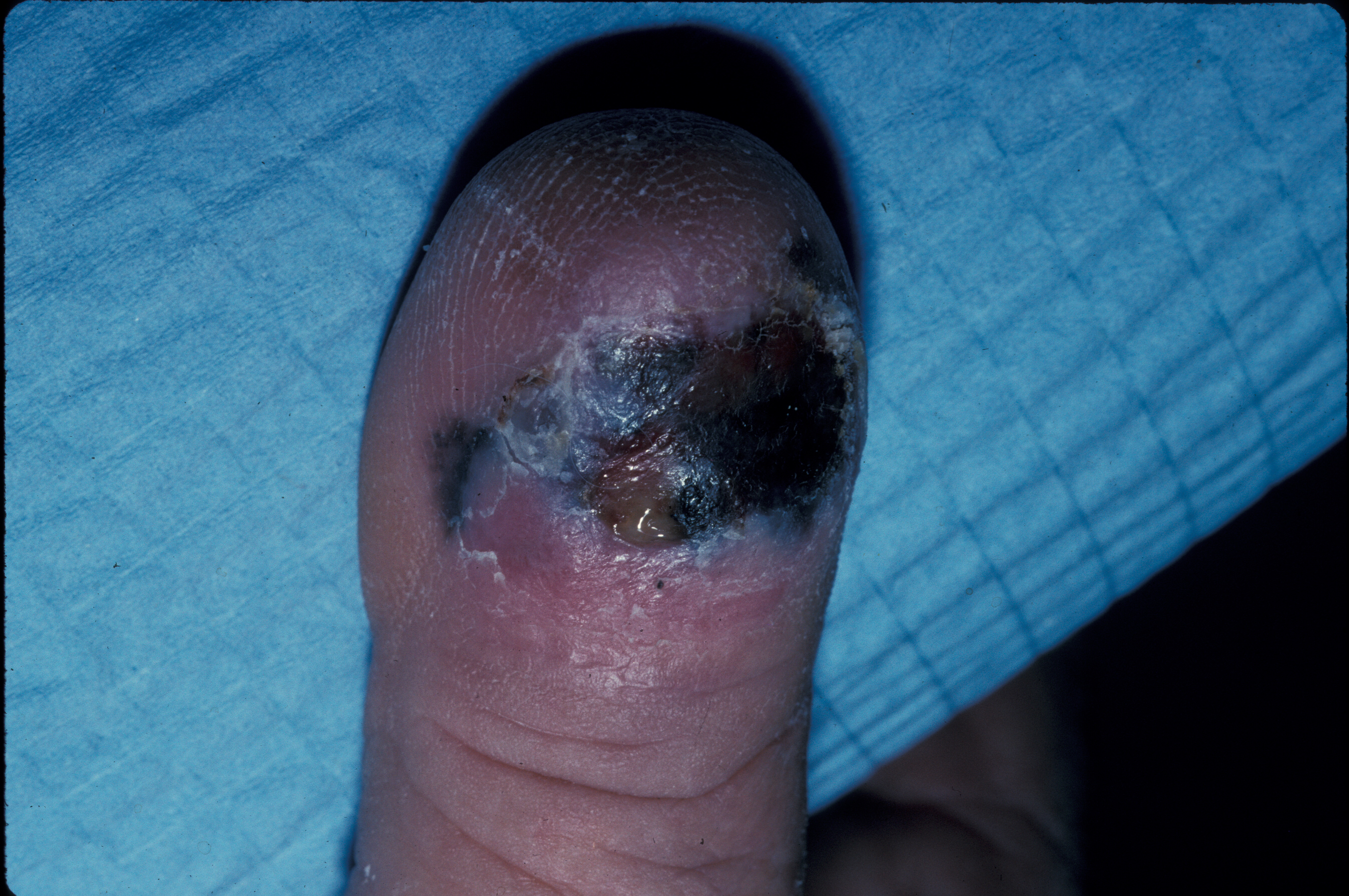 <p>Ulcerated Acral Lentiginous Melanoma on Dorsal Toe