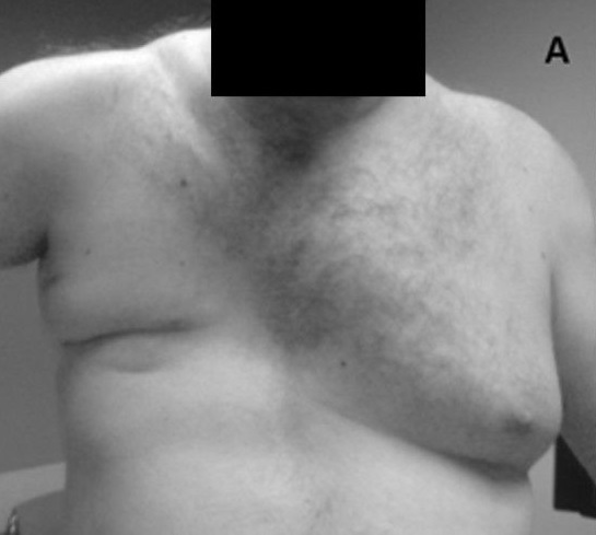 <p>Poland Syndrome With Absence of Pectoralis Major Muscle</p>