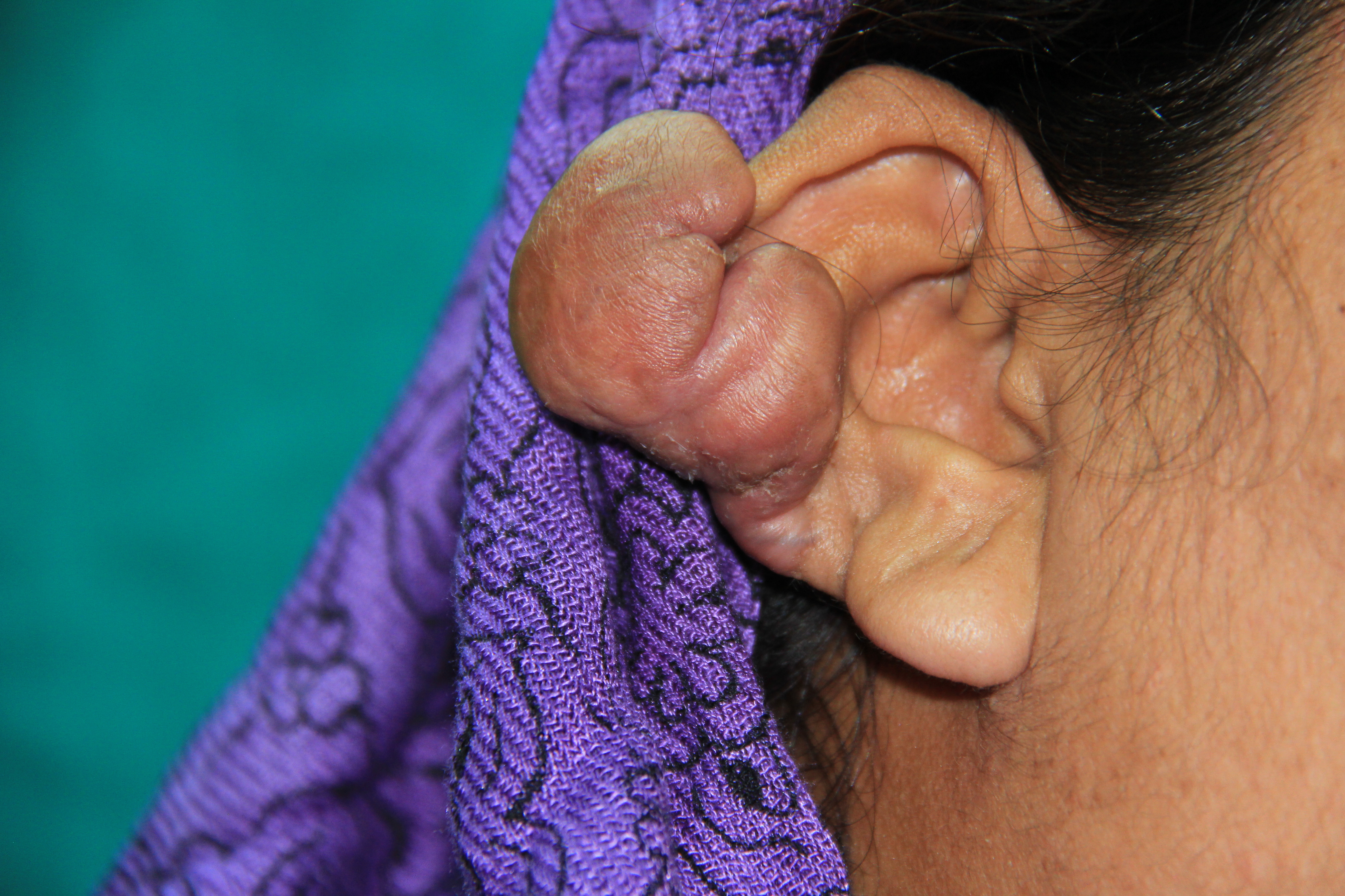 <p>Earlobe Keloids.</p>