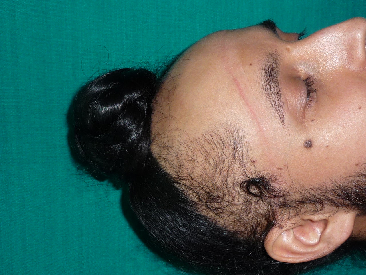 <p>Turban-Related Traction Alopecia