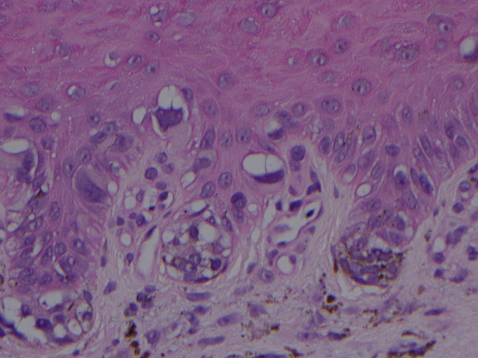 <p><em>In Situ</em> Acral Lentiginous Melanoma