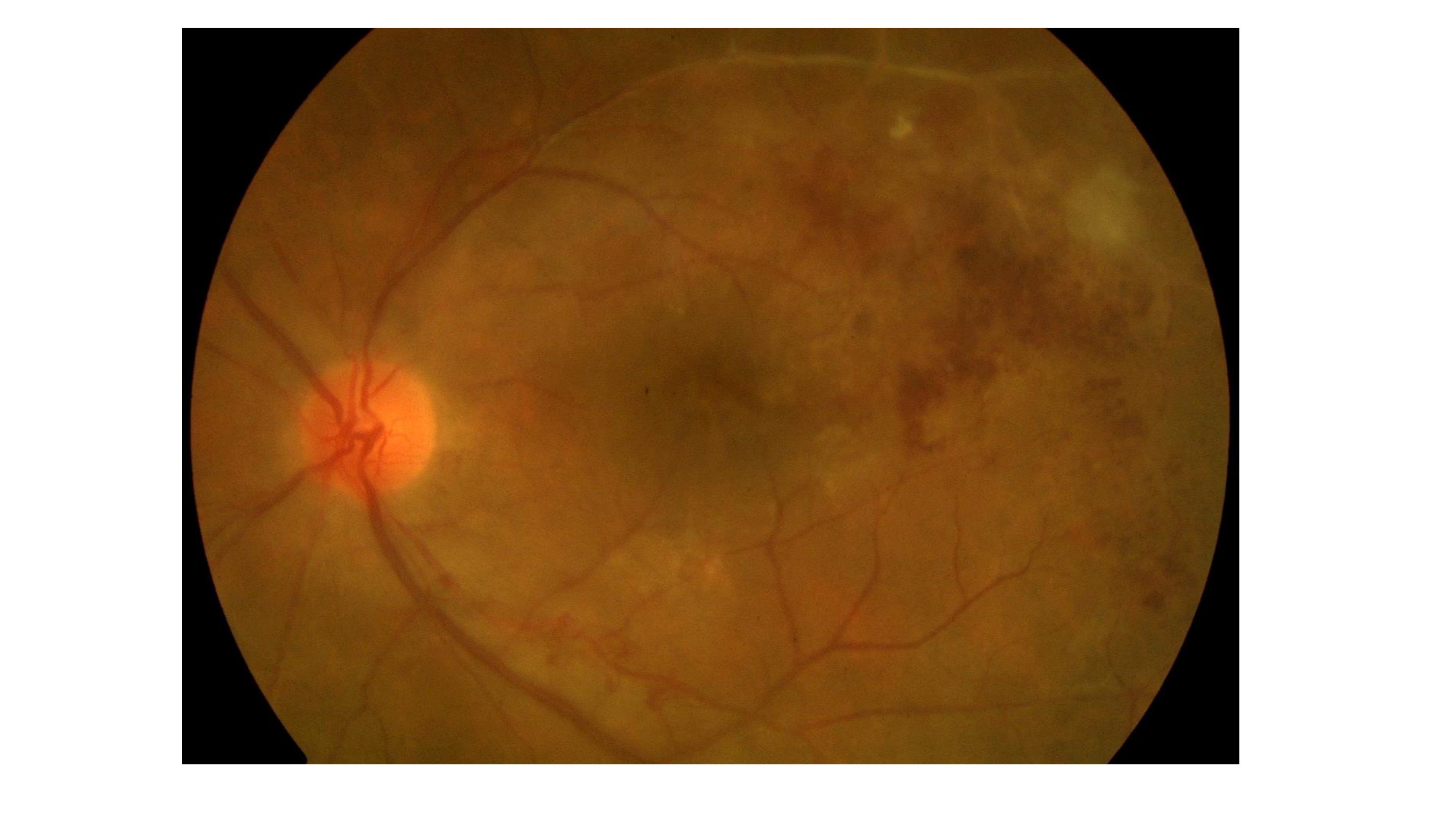 <p>Eales Disease